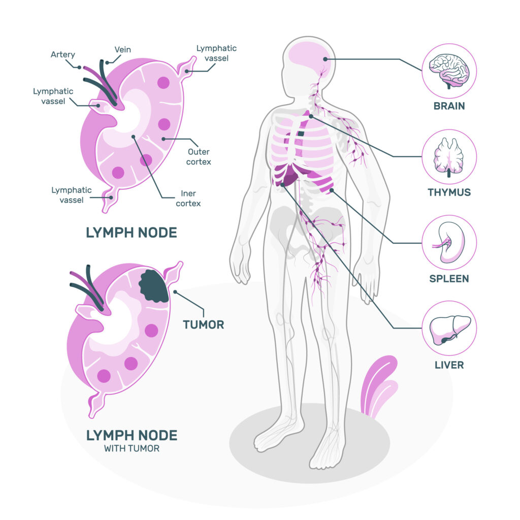 Sentinel Lymph Node Biopsy