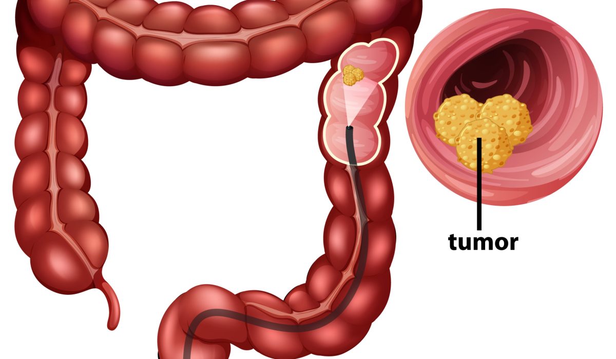 Colorectal Cancer (CRC) infographic for education illustration
