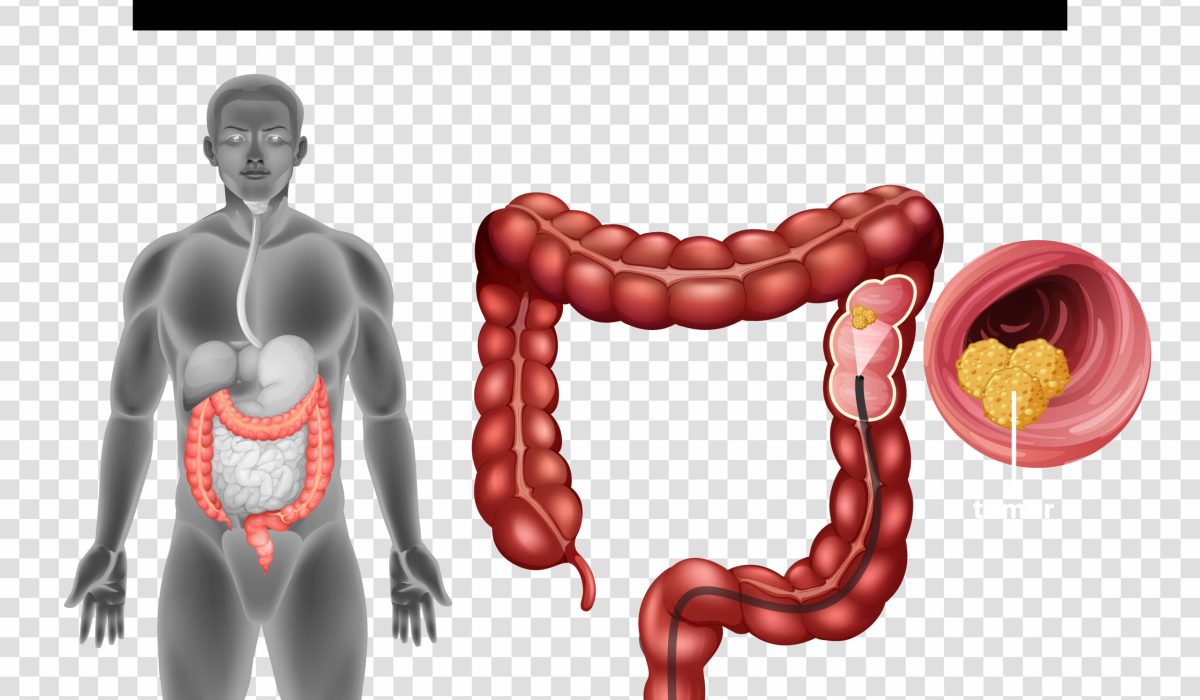 Diagram showing Colorectal Cancer (CRC) on transparent background illustration